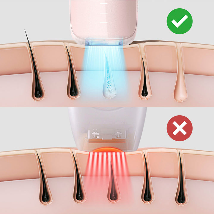 Ulike - Air 3 Ice Cooling IPL Dry Hair Removal Device - Pink_2